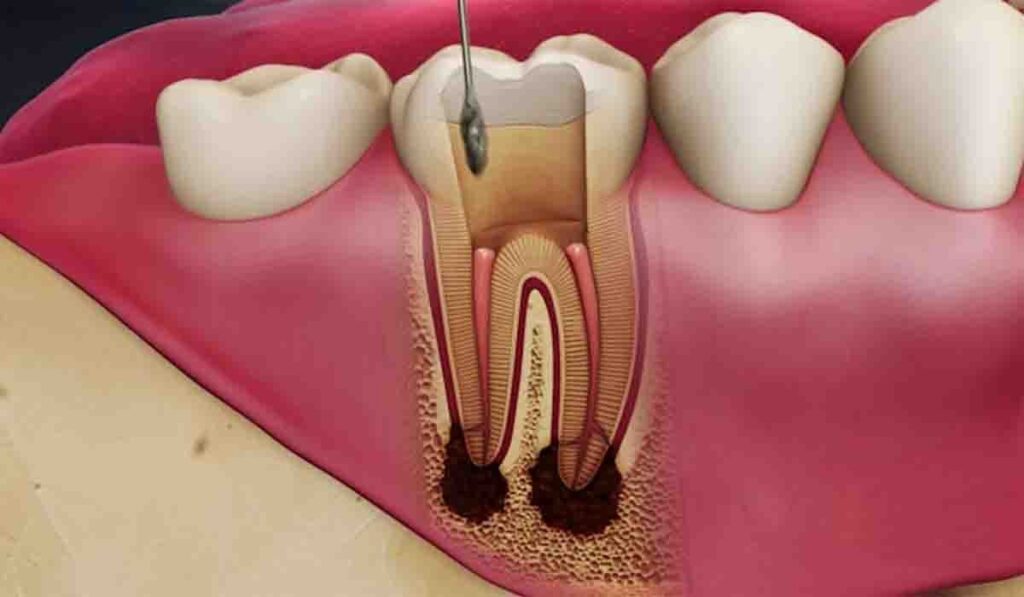 تکنولوژی‌های جدید در عصب کشی دندان