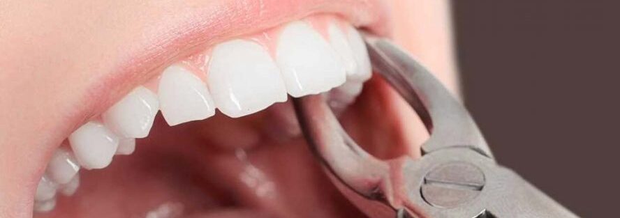 دلایل و عوارض کشیدن دندان چیست