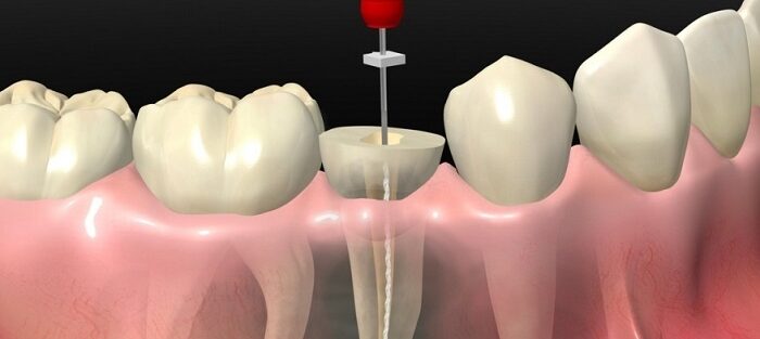 عصب کشی دندان (درمان ریشه دندان)