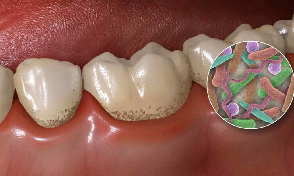 عوامل ایجاد عفونت دندان