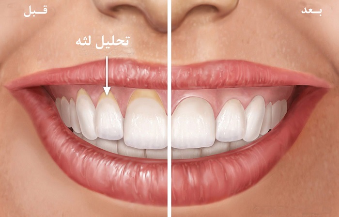 تحلیل-لثه درمان