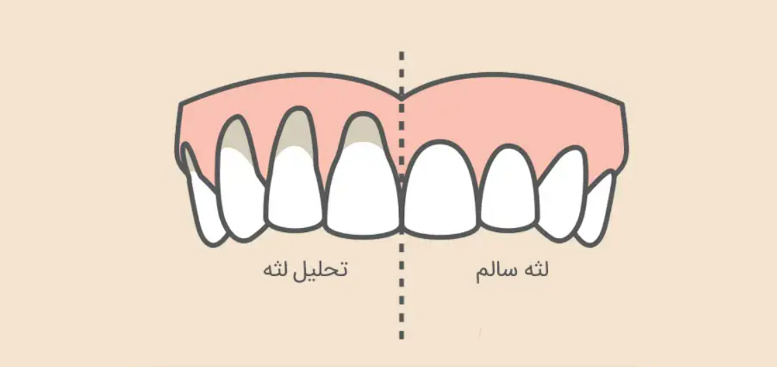 علائم پسروی لثه