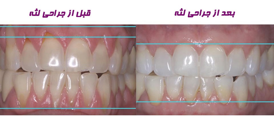 انواع جراحی لثه