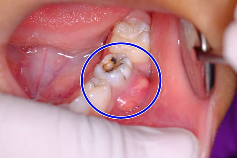 عفونت دندان عصب کشی شده بعد از چند سال