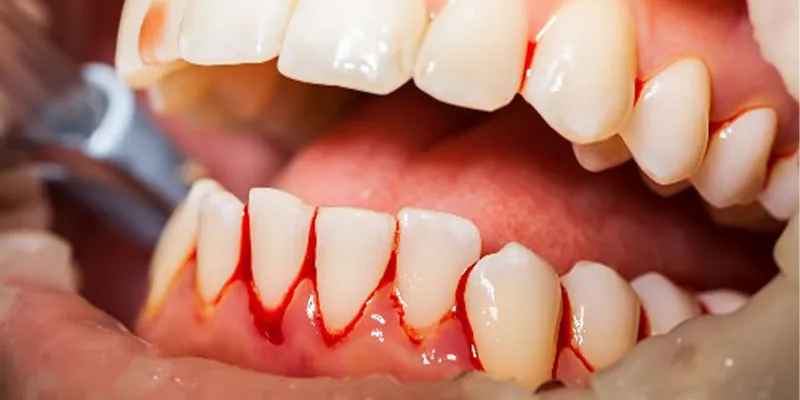 آیا خونریزی بعد از کشیدن دندان عقل خطرناک است؟