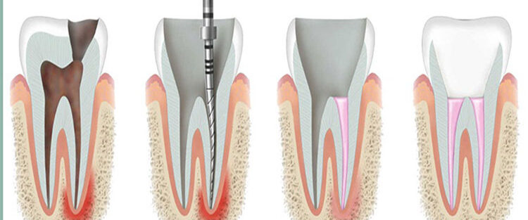 ورم و درد بعد از عصب کشی دندان