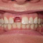 آشنایی با مهمترین دلایل از دست رفتن دندان ها