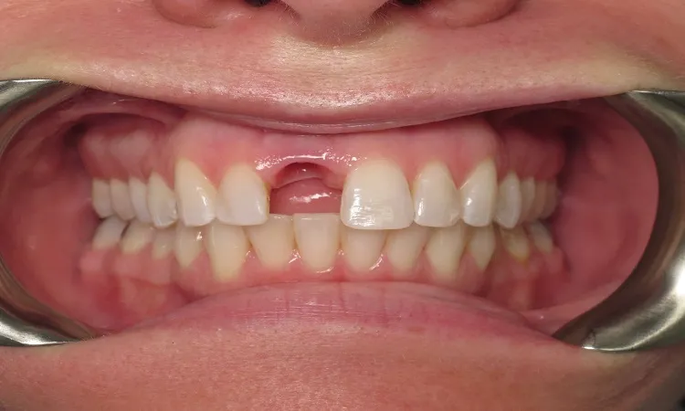 آشنایی با مهمترین دلایل از دست رفتن دندان ها
