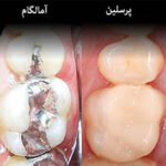 مراحل و انواع مواد پر کردن دندان