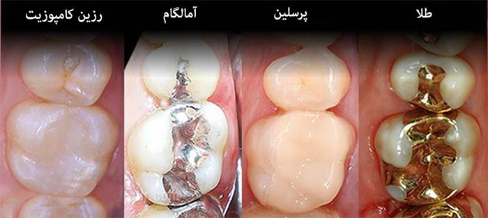 انواع مواد پر کردن دندان