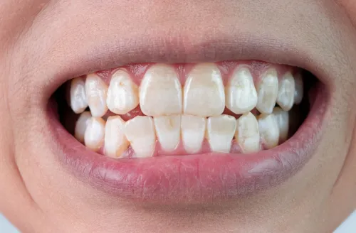 علت لکه سفید روی دندان