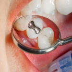 مراقبت های بعد از پر کردن دندان
