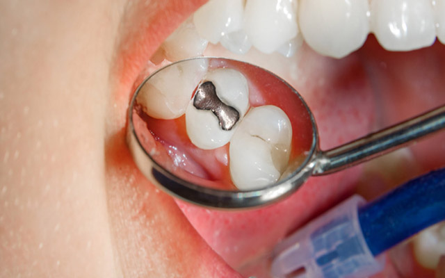 مراقبت های بعد از پر کردن دندان