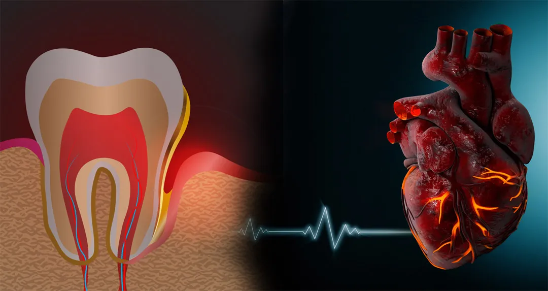 آیا عفونت دندان باعث بیماری قلبی می شود؟