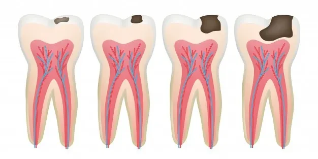 بهترین روش درمان پوسیدگی دندان چیست؟