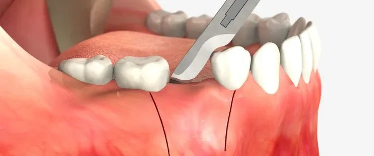 تحلیل لثه بعد از کشیدن دندان، علائم و نکات مراقبتی