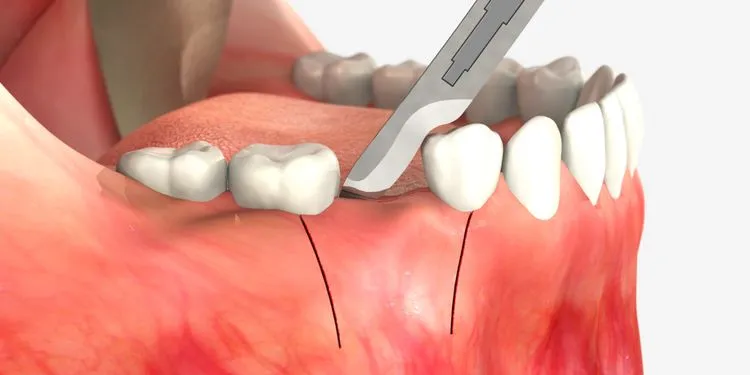 تحلیل لثه بعد از کشیدن دندان، علائم و نکات مراقبتی