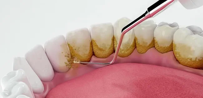 جرم گیری دندان چیست ؟ (+ انواع روش، مراحل و مزایا )
