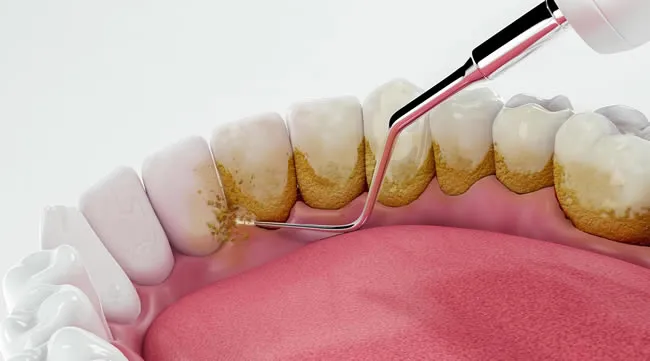 جرم گیری دندان چیست ؟ (+ انواع روش، مراحل و مزایا )