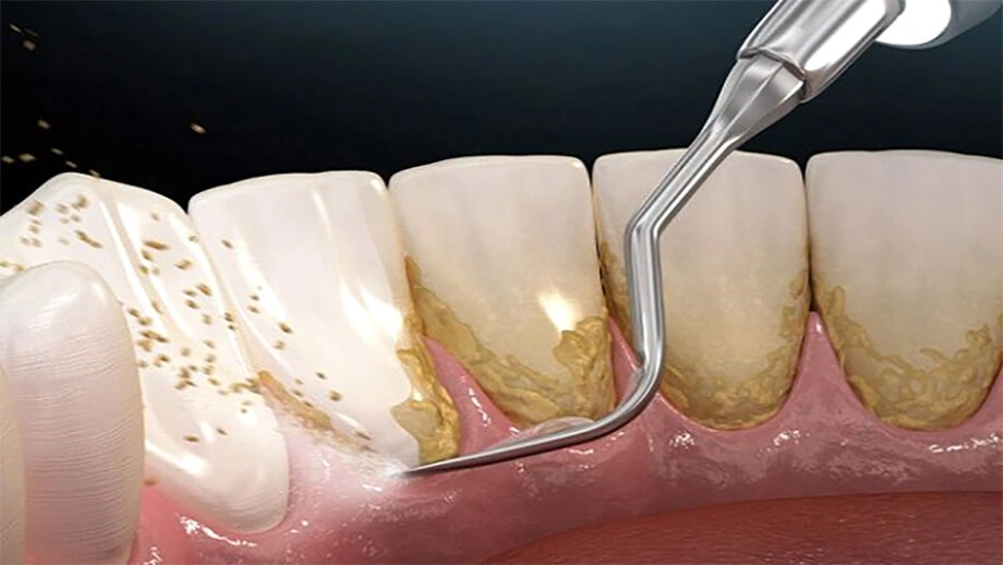 جرم گیری دندان یک روش بهداشت دهانی است که هدف از آن حذف رسوبات، پلاک، و سنگ های دندانی است که روی سطوح دندان‌ها تشکیل می‌شوند. این فرایند اهمیت زیادی در حفظ سلامت دهان و جلوگیری از بروز بیماری‌های دهانی