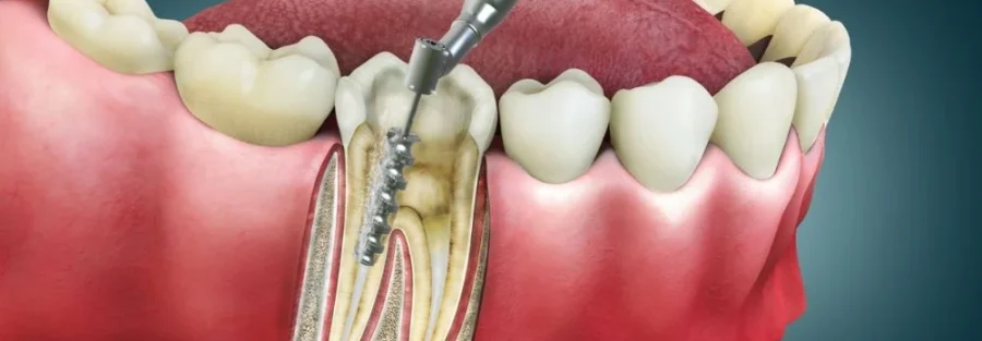 مراحل درمان روت کانال چیست؟
