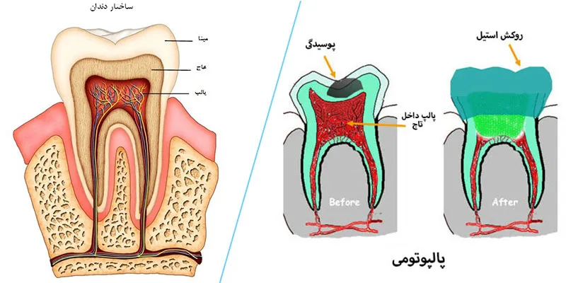 پالپوتومی دندان