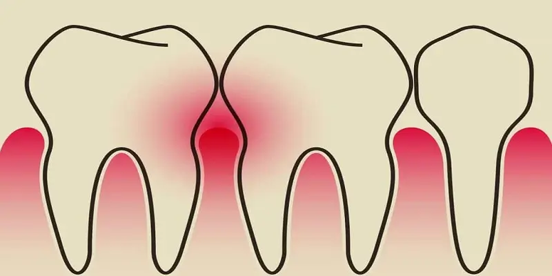 درد لثه بین دو دندان