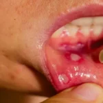 درد لثه بین دو دندان