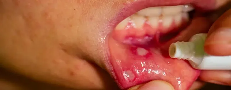 درد لثه بین دو دندان