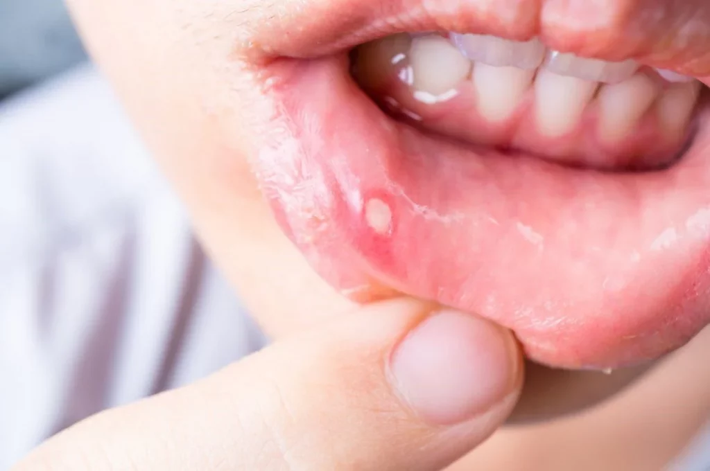 عوارض شیمی‌ درمانی بر دهان و دندان