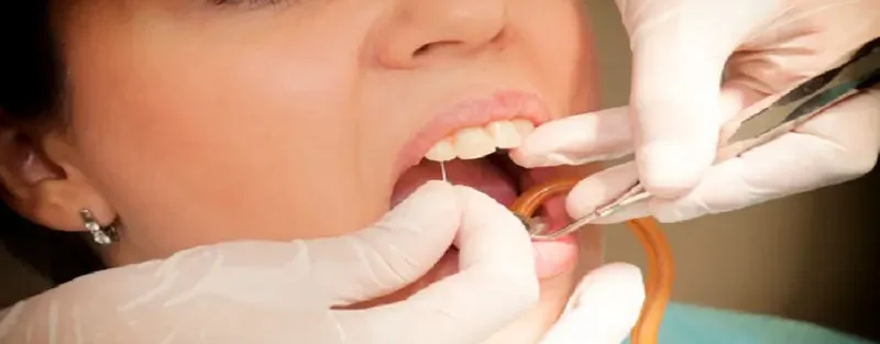 ممنوعیت کشیدن دندان