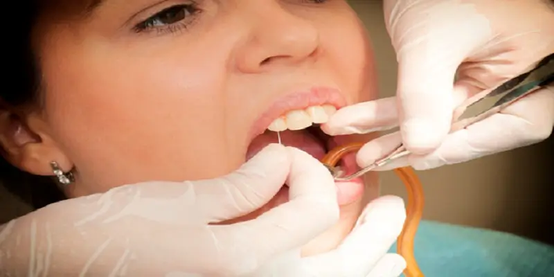 ممنوعیت کشیدن دندان