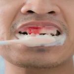 قطع فوری خونریزی دندان با طب سنتی