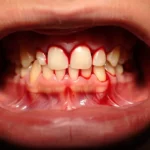 تأثیر داروهای فشار خون بر سلامت لثه و استخوان فک