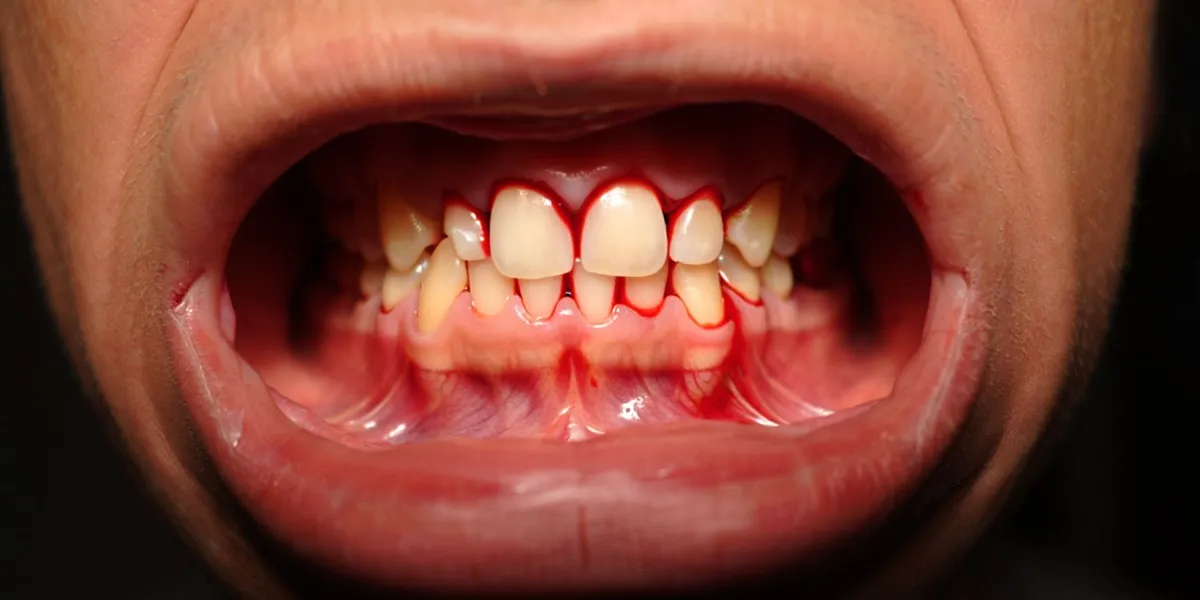 تأثیر داروهای فشار خون بر سلامت لثه