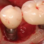 ایمنی ایمپلنت دندان در بیماران با نارسایی قلبی مزمن: بایدها و نبایدها