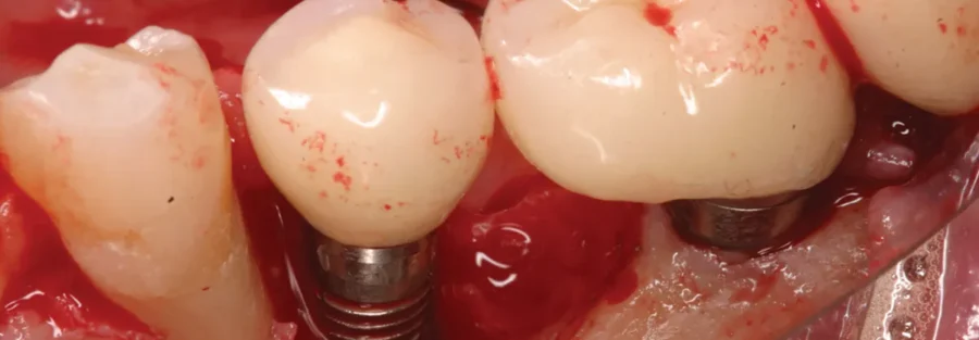 ایمنی ایمپلنت دندان در بیماران با نارسایی قلبی مزمن: بایدها و نبایدها