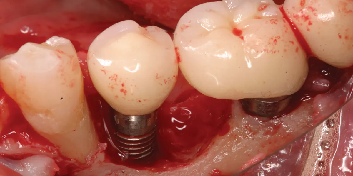 ایمنی ایمپلنت دندان در بیماران با نارسایی قلبی مزمن: بایدها و نبایدها