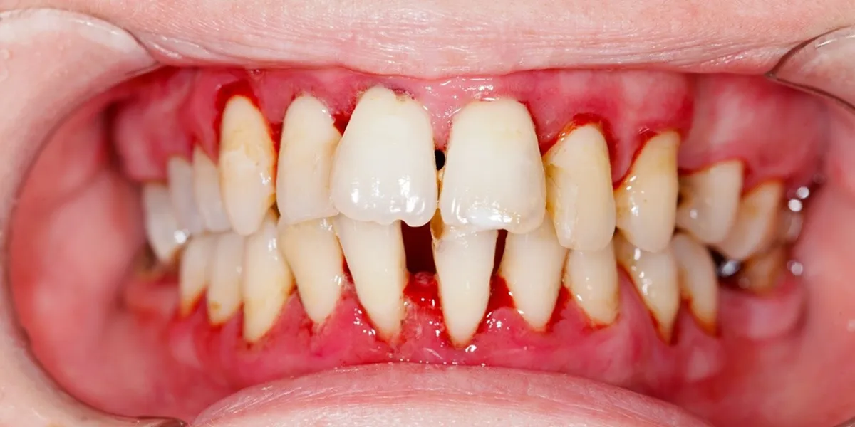 تأثیر داروهای فشار خون بر سلامت لثه