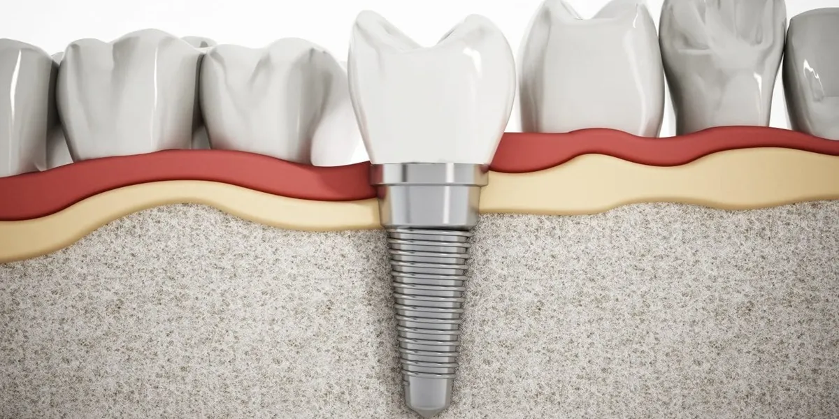ایمنی ایمپلنت دندان در بیماران با نارسایی قلبی مزمن: بایدها و نبایدها