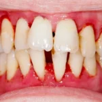 نقش دندانپزشک در تشخیص زودهنگام بیماری‌های قلبی از روی علائم دهانی