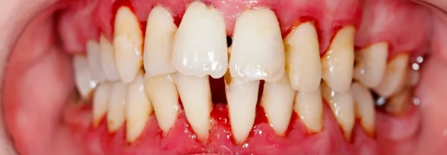 تشخیص بیماری قلبی از علائم دهانی