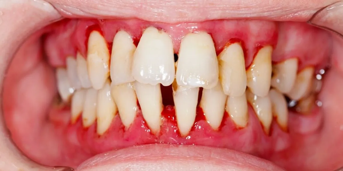 تشخیص بیماری قلبی از علائم دهانی