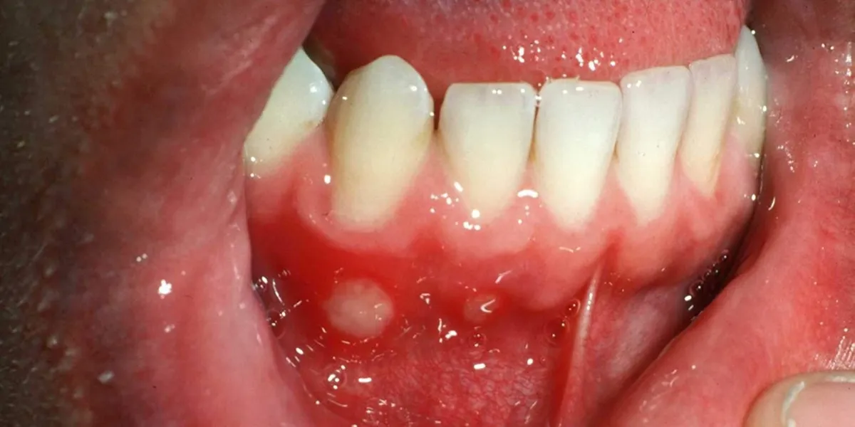 تشخیص بیماری قلبی از علائم دهانی