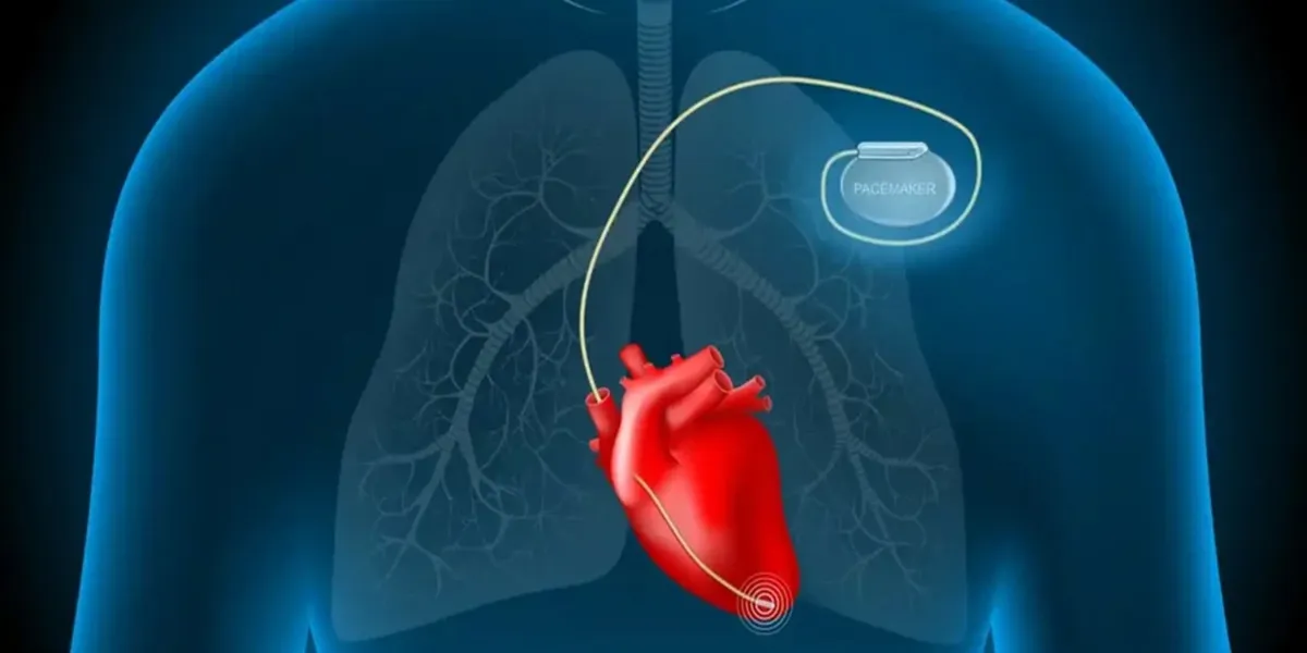 دندانپزشکی در بیماران با ضربان‌ساز قلبی
