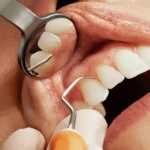 تغییرات دهان و دندان در اثر مصرف طولانی‌مدت داروهای ضدانعقاد و ضدپلاکت