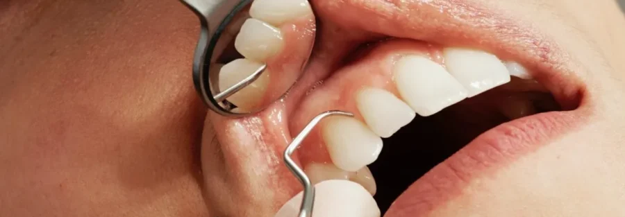 عوارض دهانی داروهای ضدانعقاد