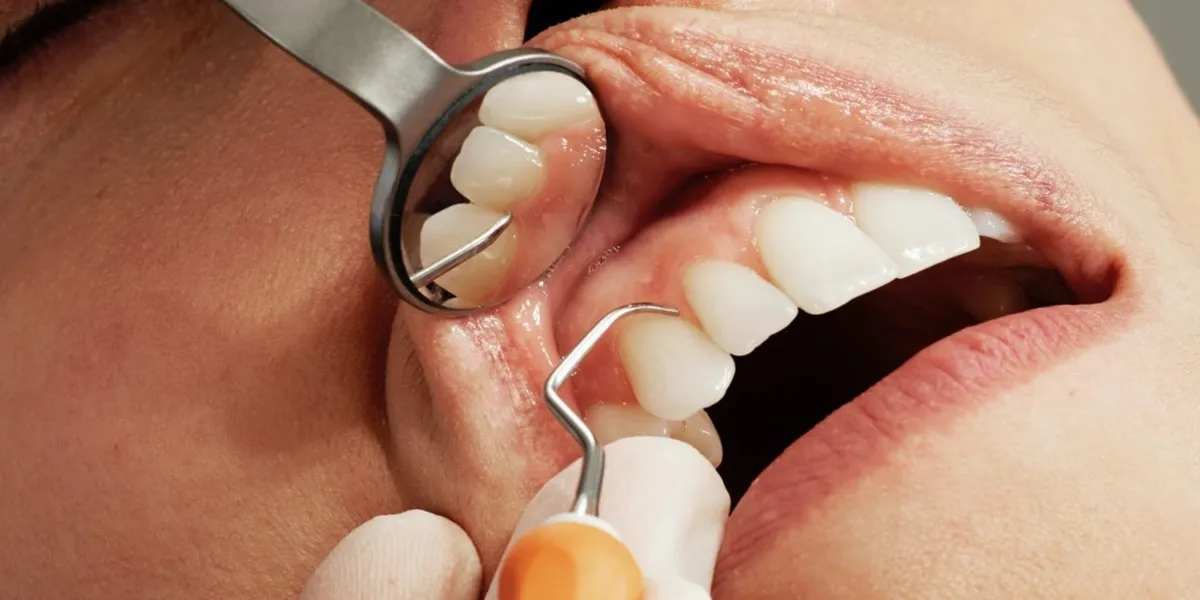 عوارض دهانی داروهای ضدانعقاد