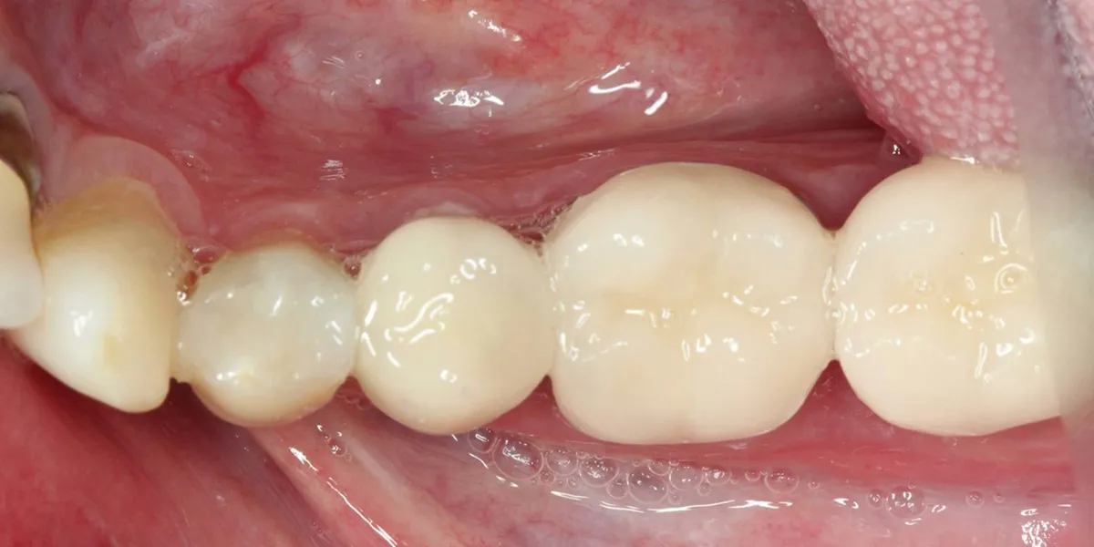 مراقبت های پس از روکش دندان برای بیماران قلبی