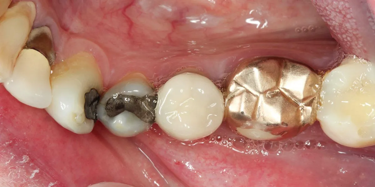 مراقبت های پس از روکش دندان برای بیماران قلبی